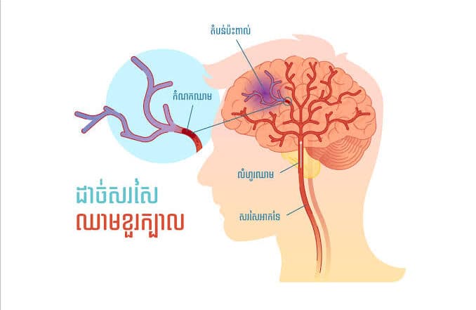 腦腫瘤的危險因子 (醫學上最常用、最自然)